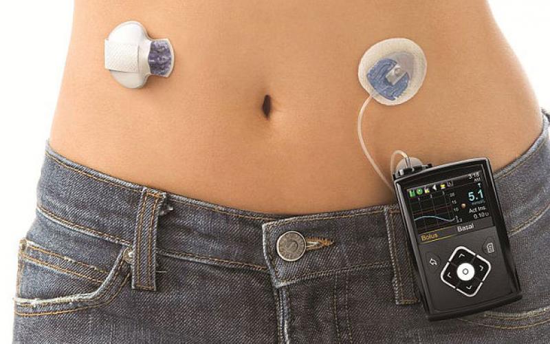 ΤΕΧΝΗΤΟ ΠΑΓΚΡΕΑΣ