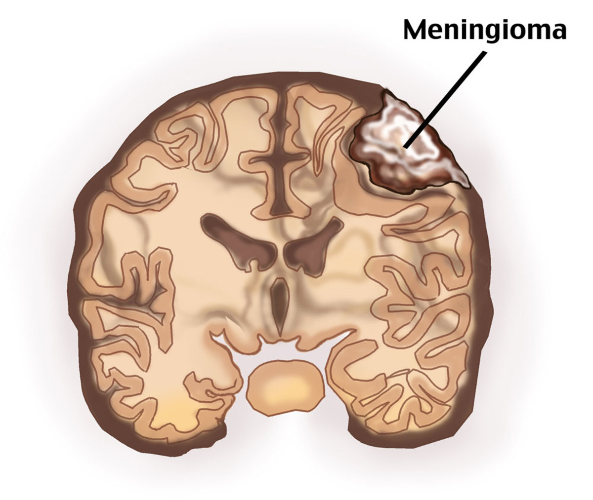 После 40 головного мозга. Опухоль головного мозга менингиома. Атипическая менингиома. Менингиома доброкачественная. Доброкачественная опухоль головного мозга менингиома.