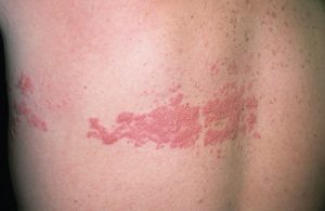 Έρπης ζωστήρας : μια σοβαρή δερματοπάθεια με σοβαρές επιπτώσεις.