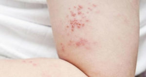 Έρπης ζωστήρας : μια σοβαρή δερματοπάθεια με σοβαρές επιπτώσεις.