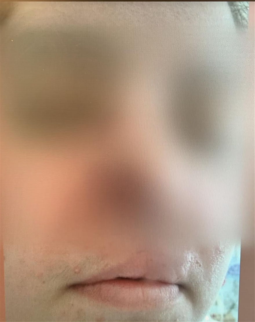 Πιτ μπουλ 35χρονης την έστειλε στο νοσοκομείο.