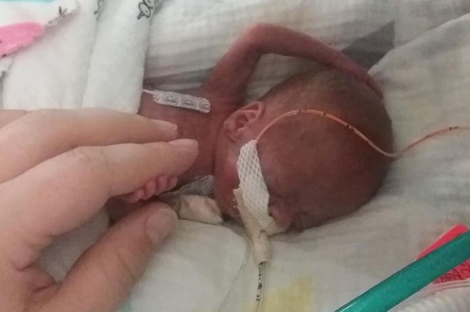 Το πιο πρόωρο μωρό στον κόσμο επιβίωσε 