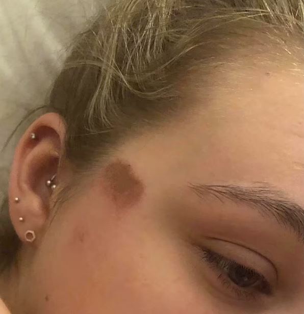 μεθύσι από νοθευμένο ποτό