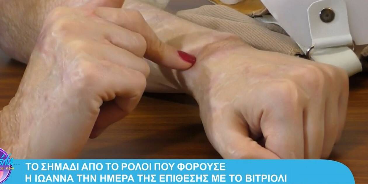 Η Ιωάννα Παλιοσπύρου δείχνει τα ρούχα από την επίθεση με βιτριόλι 