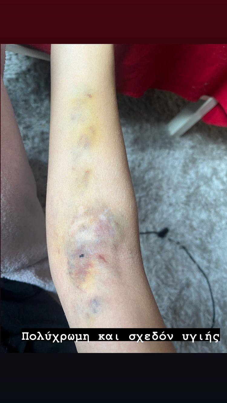 Μαρία Μιχαλοπούλου αιμαγγείωμα 