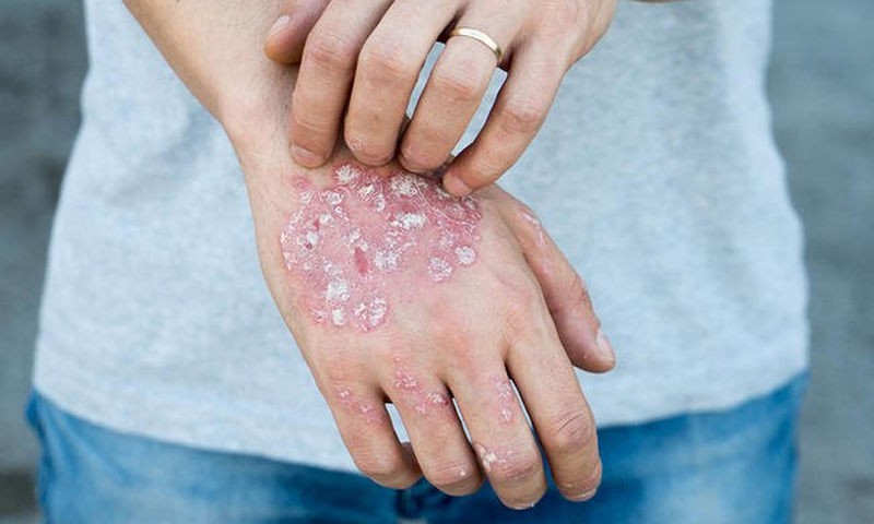 Τα αυτοάνοσα νοσήματα που χτυπούν τις γυναίκες 