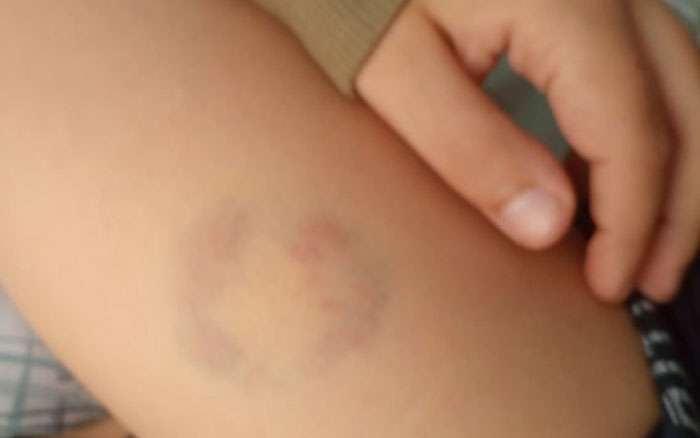 Διευθύντρια ειδικού σχολείου δάγκωσε μαθητή