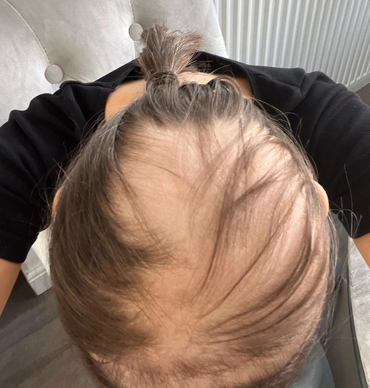 26χρονη όγκος στον εγκέφαλο