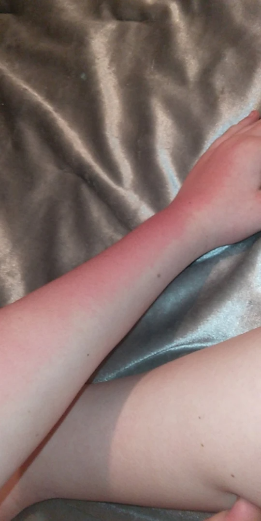 14χρονη έχει αλλεργία στο νερό 