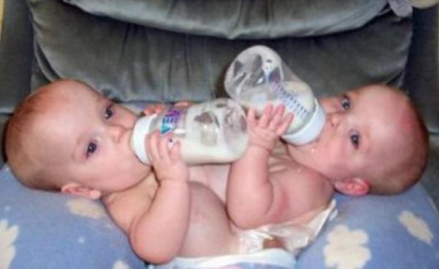 σιαμαίες δίδυμες