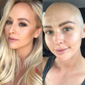 μαστογραφία